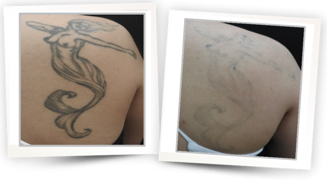 Tattoo Removal (2)