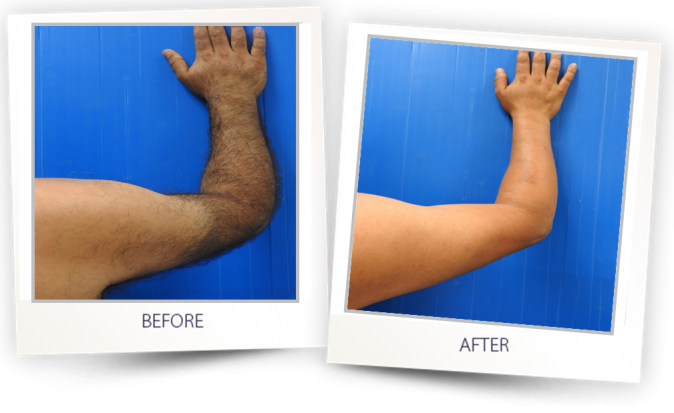 Hair-Removal