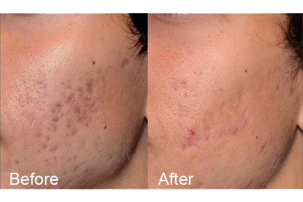 acne-before-&-after