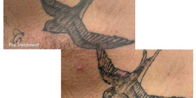 Tattoo-Removal-before-&-after-2