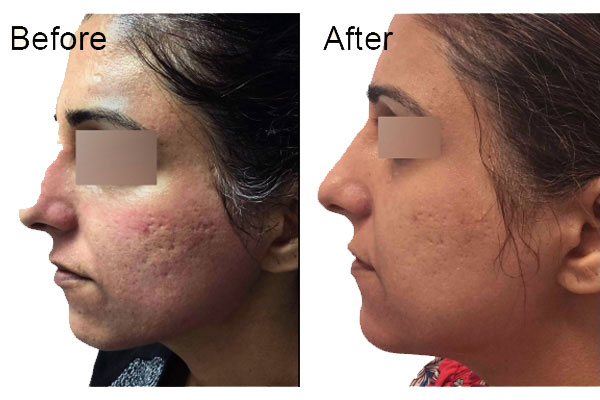 acne-before-&-after-1