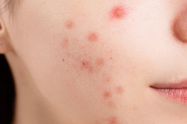 Plagued-by-acne-breakouts-Zap-those-zits-with-our-acne-removal-treatment!