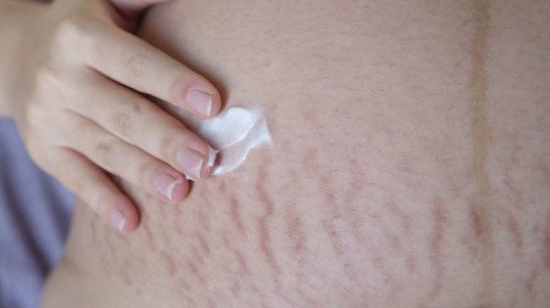 What-are-stretch-marks-and-how-to-get-rid-of-them