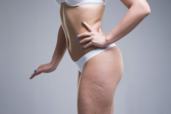 The Ultimate Guide to Eradicate Cellulite