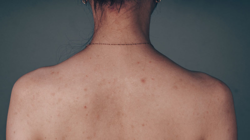 Get-the-removal-your-ance-scar