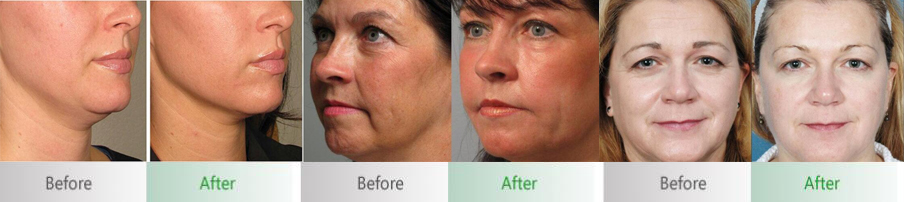 Before&After HIFU-Q3&Q6+