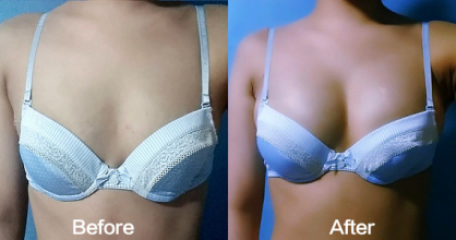 Before&After  Breast Fit Machine