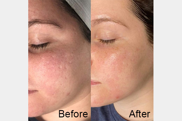 Acne before & after