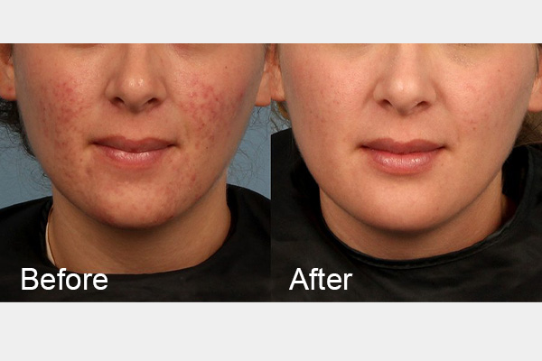 Acne before & after