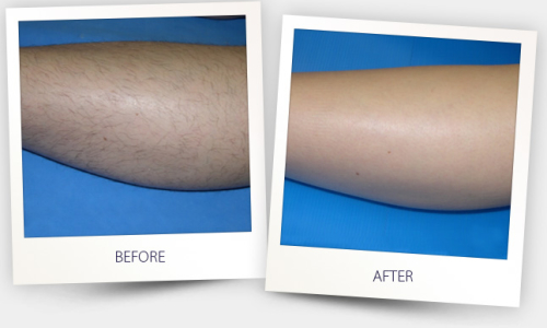 Before&After  treatment