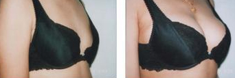 Before&After  Breast Fit Machine