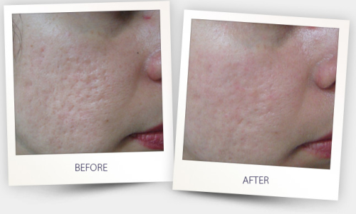 Courtesy of Maria Claudia Issa, MD &PhD in Dermatology, Rio de Janeiro, Brazil