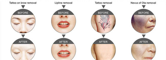 Before & after tattoo removal