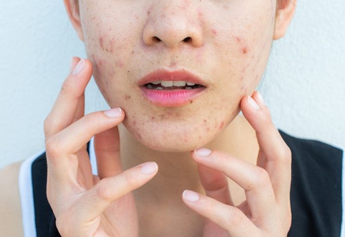 5 acne myths you need to stop believing!