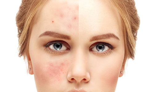 Fractional-CO2-Laser-Treatment-for-Acne-Scars-Is-It-Effective