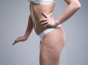 The Ultimate Guide to Eradicate Cellulite