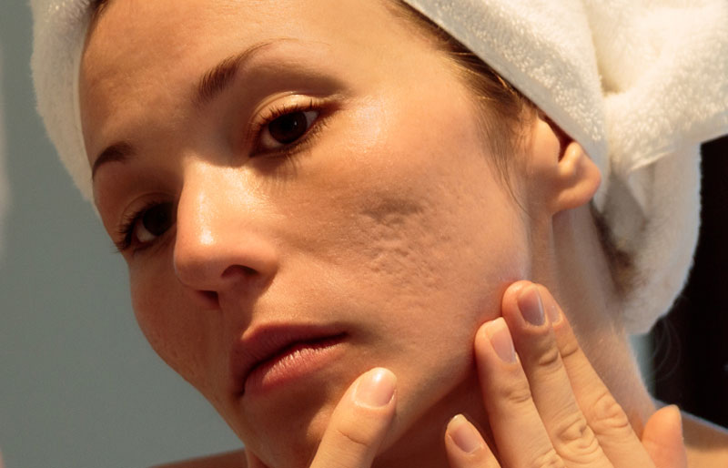 How-to-treat-deep-pitted-acne-scars