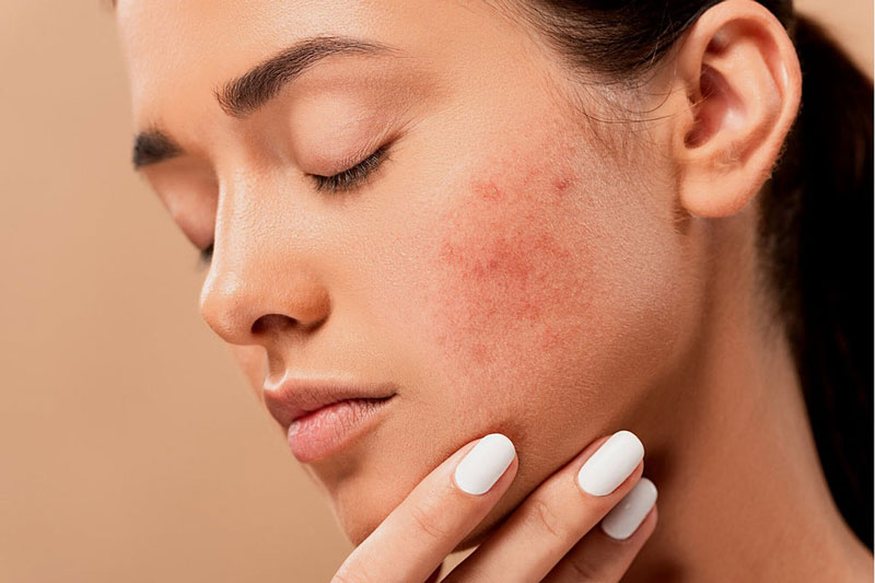 How-can-you-treat-acne-scars