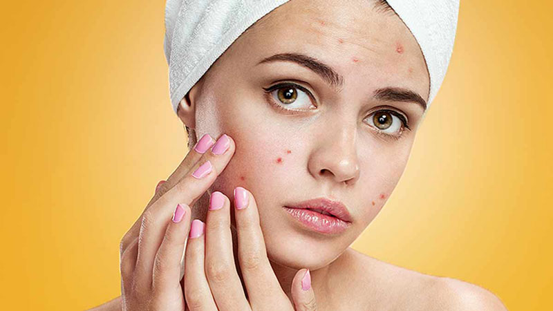 Should-you-do-something-about-acne-scars