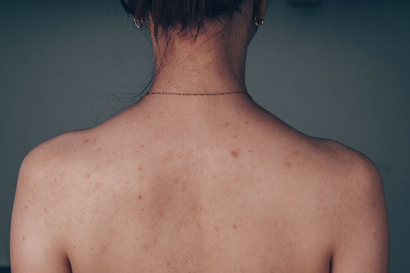 Get-the-removal-your-ance-scar