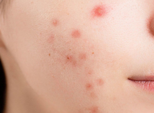 Plagued-by-acne-breakouts-Zap-those-zits-with-our-acne-removal-treatment!
