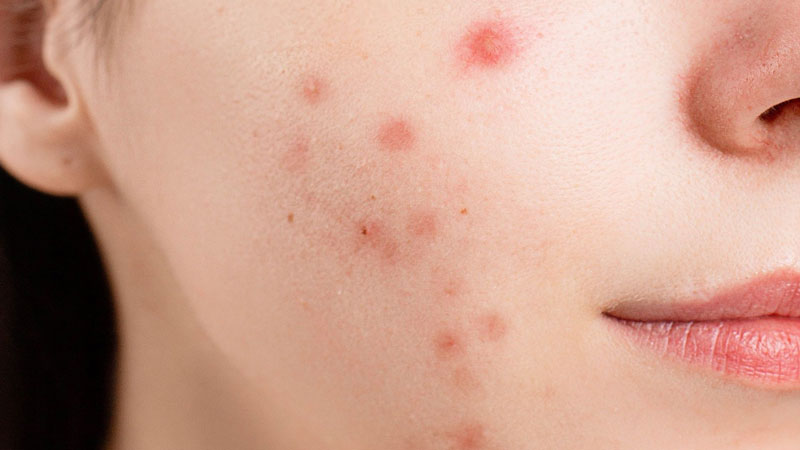 Plagued-by-acne-breakouts-Zap-those-zits-with-our-acne-removal-treatment!