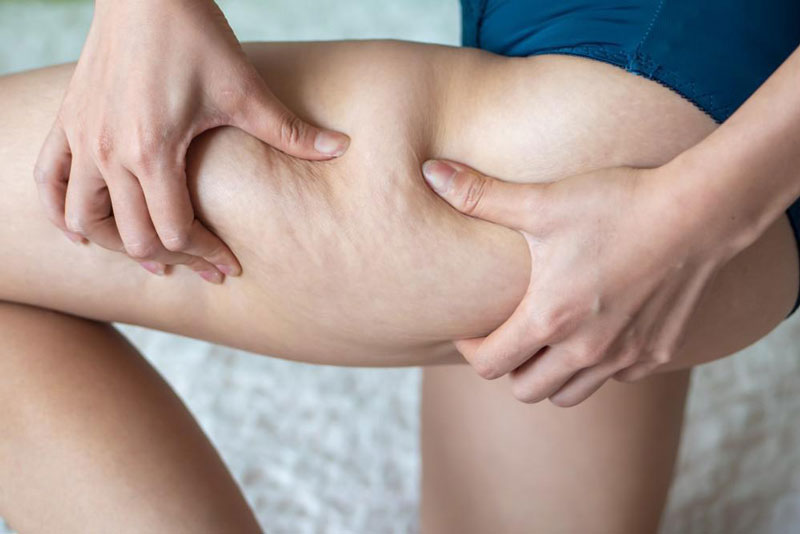 How-Long-Does-It-Take-to-See-Results-From-Velashape-Cellulite-Treatment