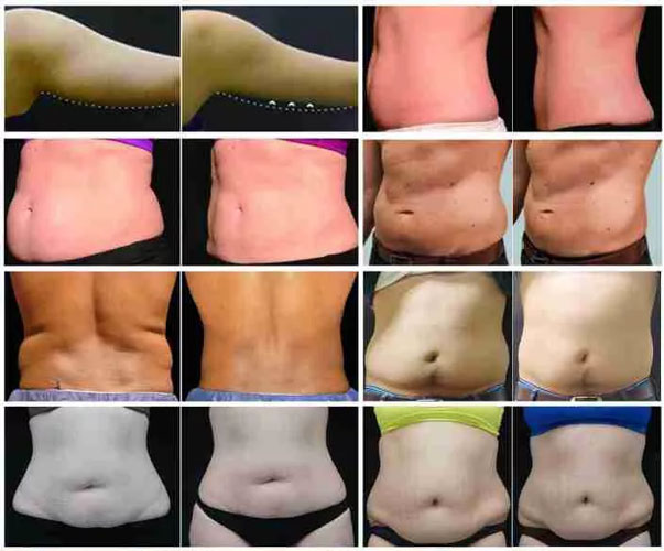 before-after
