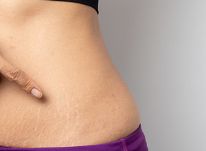 The Only Real Way to Say Goodbye to Your Stretchmarks