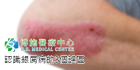 認識銀屑病的3個誤區
