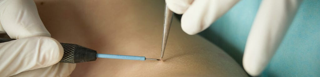 wart-removal-colorado-springs-1024x248