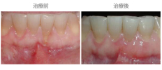 牙齦覆蓋術-案例03