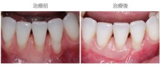 牙齦覆蓋術-案例05