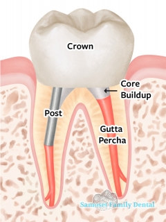 7.4 Post and Crown