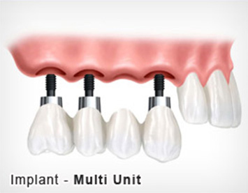 implant-Muti