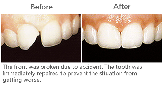 broken teeth