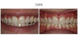 牙冠延長術-案例02-1