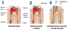 root-canal-stages-1