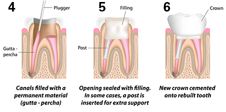 root-canal-stages-2