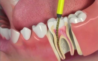 7.3 Root Canal Therapy