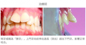 牙齒整齊排列-案例5