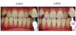 牙齒美白01