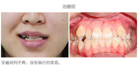 牙齒整齊排列-案例1