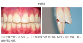 牙齒整齊排列-案例5-1