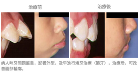 牙齒整齊排列-案例2
