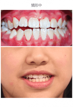 牙齒整齊排列-案例8-1