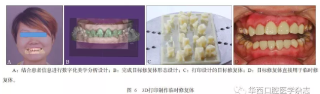 3D打印医疗行业深度解析：3D打印在口腔美学修复中的应用 (7).png