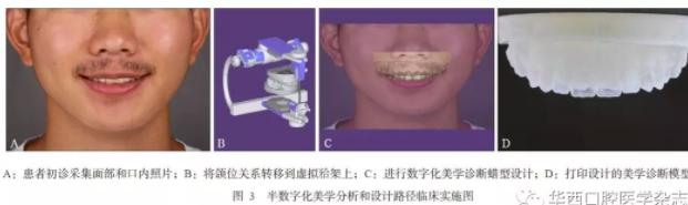 3D打印医疗行业深度解析：3D打印在口腔美学修复中的应用 (4).png