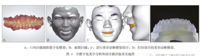 3D打印医疗行业深度解析：3D打印在口腔美学修复中的应用 (5).png
