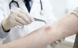 A doctor carefully tends to a patient’s forearm and gently lifts the edge of a paraffin gauze dressing to inspect the healing wound beneath.